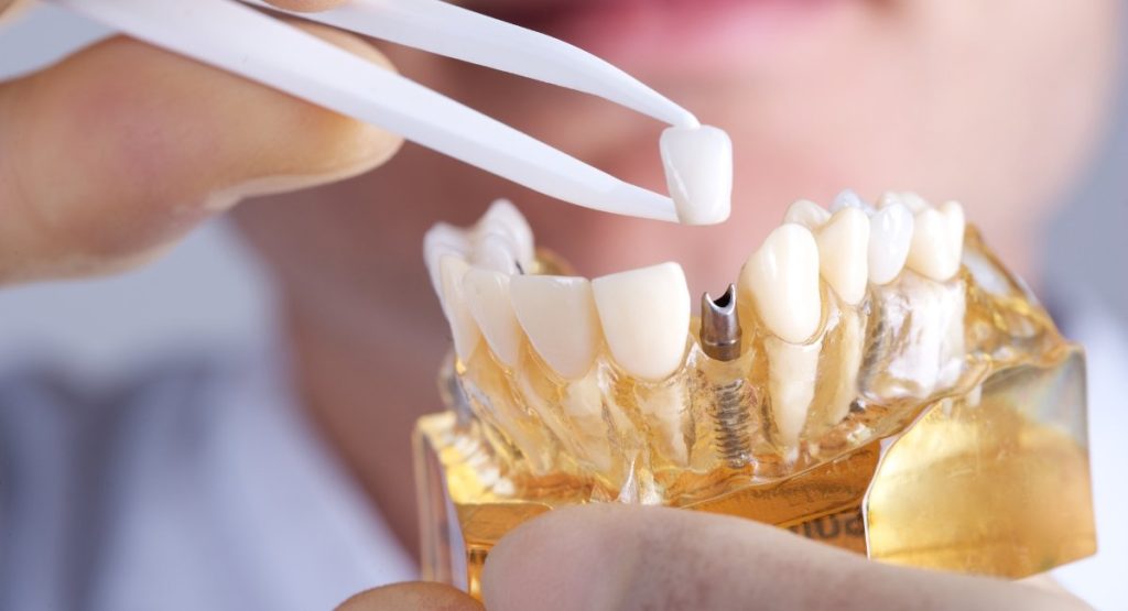 Dental Implants Melbourne