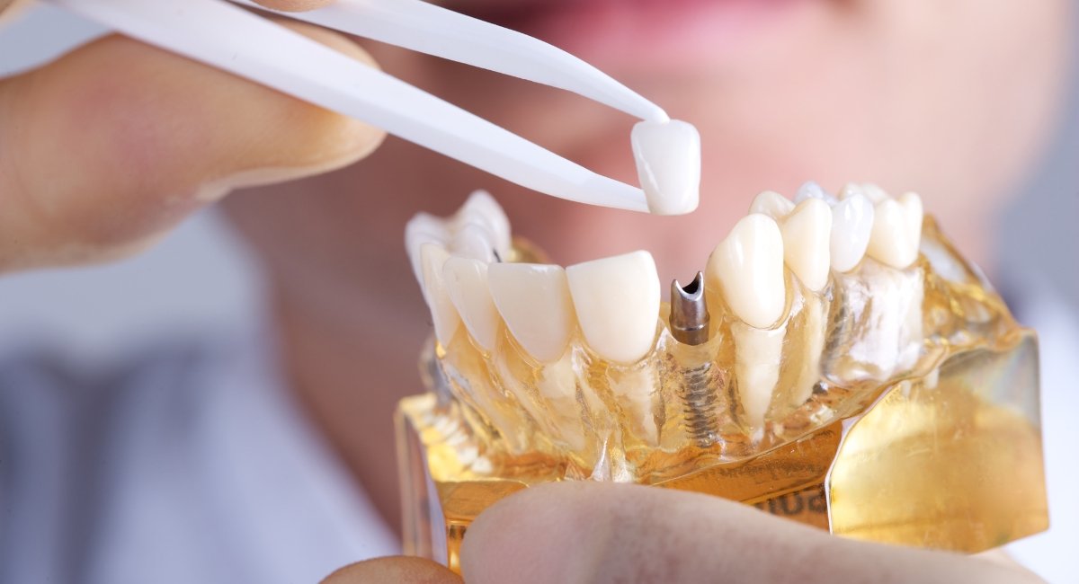 Dental Implants Melbourne